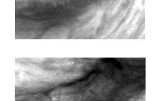 <h1>PIA00724:  Mesoscale Waves in Jupiter's Atmosphere</h1><div class="PIA00724" lang="en" style="width:513px;text-align:left;margin:auto;background-color:#000;padding:10px;max-height:150px;overflow:auto;">These two images of Jupiter's atmosphere were taken with the violet filter of the Solid State Imaging (CCD) system aboard NASA's Galileo spacecraft. The images were obtained on June 26, 1996; the lower image was taken approximately one rotation (9 hours) later than the upper image.<p>Mesoscale waves can be seen in the center of the upper image. They appear as a series of about 15 nearly vertical stripes; the wave crests are aligned north-south. The wave packet is about 300 kilometers in length and is aligned east-west. In the lower image there is no indication of the waves, though the clouds appear to have been disturbed. Such waves were seen also in images obtained by NASA's Voyager spacecraft in 1979, though lower spatial and time resolution made tracking of features such as these nearly impossible.<p>Mesoscale waves occur when the wind shear is strong in an atmospheric layer that is sandwiched vertically between zones of stable stratification. The orientation of the wave crests is perpendicular to the shear. Thus, a wave observation gives information about how the wind direction changes with height in the atmosphere.<p>North is at the top of these images which are centered at approximately 15 South latitude and 307 West longitude. In the upper image, each picture element (pixel) subtends a square of about 36 kilometers on a side, and the spacecraft was at a range of more than 1.7 million kilometers from Jupiter. In the lower image, each pixel subtends a square of about 30 kilometers on a side, and the spacecraft was at a range of more than 1.4 million kilometers from Jupiter.<p>The Jet Propulsion Laboratory, Pasadena, CA manages the mission for NASA's Office of Space Science, Washington, DC.<p>This image and other images and data received from Galileo are posted on the World Wide Web, on the Galileo mission home page at URL http://galileo.jpl.nasa.gov. Background information and educational context for the images can be found at <a href="http://www2.jpl.nasa.gov/galileo/sepo/" target="_blank">http://www.jpl.nasa.gov/galileo/sepo</a>..<br /><br /><a href="http://photojournal.jpl.nasa.gov/catalog/PIA00724" onclick="window.open(this.href); return false;" title="Voir l'image 	 PIA00724:  Mesoscale Waves in Jupiter's Atmosphere	  sur le site de la NASA">Voir l'image 	 PIA00724:  Mesoscale Waves in Jupiter's Atmosphere	  sur le site de la NASA.</a></div>