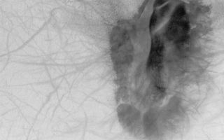 <h1>PIA05259:  Dune and Dust Devil Tracks</h1><div class="PIA05259" lang="en" style="width:799px;text-align:left;margin:auto;background-color:#000;padding:10px;max-height:150px;overflow:auto;">31 January 2004 <br /> This Mars Global Surveyor (MGS) Mars Orbiter Camera (MOC) image shows a dark sand dune patch that occurs on the floor of a southern hemisphere crater near 64.1°S, 197.2°W. Passing dust devils have disrupted the fine, bright dust that coats the surrounding terrain, leaving wildly-varied streak patterns. Dark dots to the left (west) of the dune are boulders. The picture covers an area 3 km (1.9 mi) wide; sunlight illuminates the scene from the upper left.<br /><br /><a href="http://photojournal.jpl.nasa.gov/catalog/PIA05259" onclick="window.open(this.href); return false;" title="Voir l'image 	 PIA05259:  Dune and Dust Devil Tracks	  sur le site de la NASA">Voir l'image 	 PIA05259:  Dune and Dust Devil Tracks	  sur le site de la NASA.</a></div>