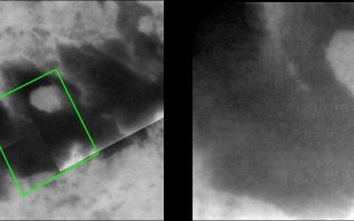 <h1>PIA06233:  Angular Bright Spot</h1><div class="PIA06233" lang="en" style="width:800px;text-align:left;margin:auto;background-color:#000;padding:10px;max-height:150px;overflow:auto;"><p>A new image of Titan taken by Cassini provides a closer, clearer view of an interesting bright feature surrounded by darker material.</p><p>During the two most recent flybys of Titan, on March 31 and April 16, 2005, Cassini captured a number of images of the hemisphere of Titan that faces Saturn. The image at the left is taken from a mosaic of images obtained in March 2005 (see <a href="/catalog/PIA06222">PIA06222</a>) and shows the location of the new image at the right. The image at the right shows an intriguing bright spot as well as the southern boundary of the dark terrain that dominates the equatorial region of this hemisphere of Titan.</p><p>The 80-kilometer-wide (50-mile) bright spot seen in the upper right portion of the image at the left was first seen in images taken during a distant encounter with Titan shortly after Cassini's Saturn orbit insertion burn in July 2004. In images taken in March, this spot was shown to be roughly circular but new, higher-resolution images like the one at the right reveal surprisingly angular edges. The angular margins suggest that they have been influenced by tectonic processes (for example, faulting). The sharp western margins and more diffuse bright material off the eastern margin are consistent with bright features seen within dark terrain in the region of Titan observed during previous flybys late last year and in February (see <a href="/catalog/PIA06541">PIA06541</a>). The west-east nature of these features is consistent with "wakes" being formed through wind-driven activity. It is also worth noting that this bright spot appears to be partly surrounded by thin, curving tendrils of bright material.</p><p>The view at the left consists of five images that have been added together and enhanced to bring out surface detail and to reduce noise, although some camera artifacts remain. </p><p>These images were taken with the Cassini spacecraft narrow-angle camera using a filter sensitive to wavelengths of infrared light centered at 938 nanometers -- considered to be the imaging science subsystem's best spectral filter for observing the surface of Titan. This view was acquired from a distance of approximately 43,000 kilometers (26,700 miles). The pixel scale of this image is 510 meters (0.3 miles) per pixel, although the actual resolution is likely to be several times larger.</p><p>The Cassini-Huygens mission is a cooperative project of NASA, the European Space Agency and the Italian Space Agency. The Jet Propulsion Laboratory, a division of the California Institute of Technology in Pasadena, manages the mission for NASA's Science Mission Directorate, Washington, D.C. The Cassini orbiter and its two onboard cameras were designed, developed and assembled at JPL. The imaging team is based at the Space Science Institute, Boulder, Colo.</p><p>For more information about the Cassini-Huygens mission visit <a href="http://saturn.jpl.nasa.gov">http://saturn.jpl.nasa.gov</a>. For additional images visit the Cassini imaging team homepage <a href="http://ciclops.org">http://ciclops.org</a>.</p><br /><br /><a href="http://photojournal.jpl.nasa.gov/catalog/PIA06233" onclick="window.open(this.href); return false;" title="Voir l'image 	 PIA06233:  Angular Bright Spot	  sur le site de la NASA">Voir l'image 	 PIA06233:  Angular Bright Spot	  sur le site de la NASA.</a></div>